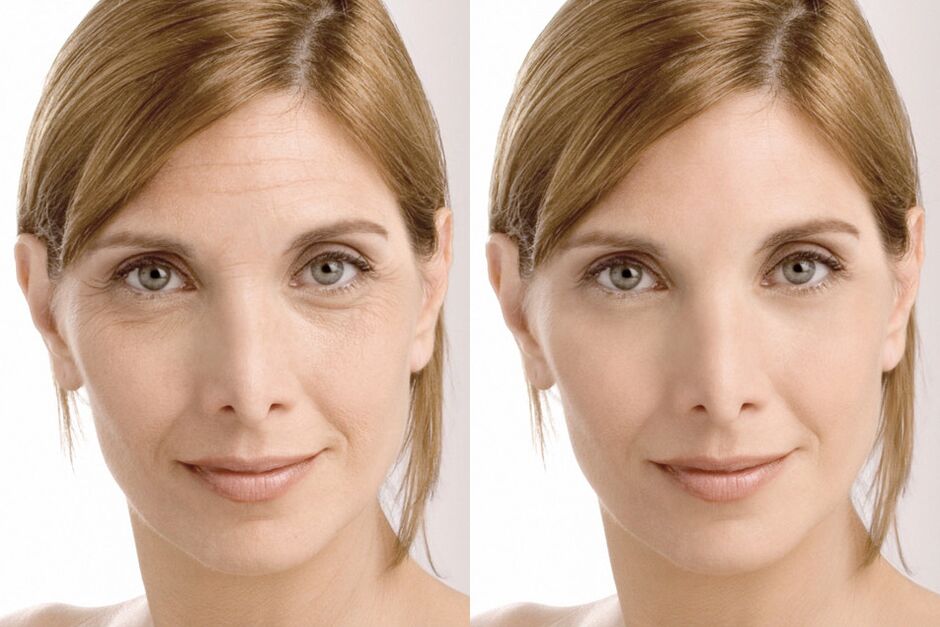 Expériences d'utilisation avant et après l'utilisation de la crème intenskin de Milana