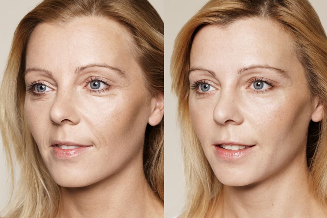 Expériences d'utilisation avant et après l'utilisation de la crème intenskin de Valeria